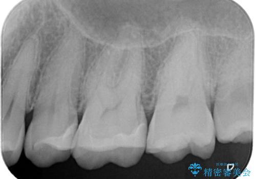 【セラミックインレー】定期検診で見つかった虫歯。の治療後