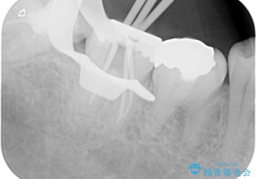 【根管治療】噛んだ時にしみる。最近になってズキズキ痛み、長引く痛みがあるの治療中