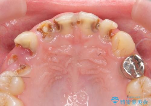 多発した前歯の重度虫歯治療