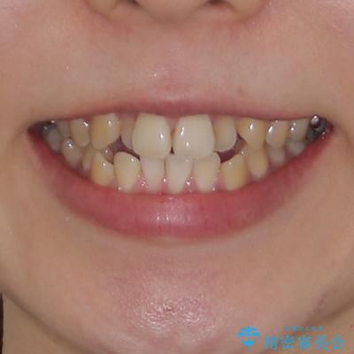 舌突出癖による開咬 舌のトレーニングを行いながら咬み合わせを改善の治療前(顔貌)