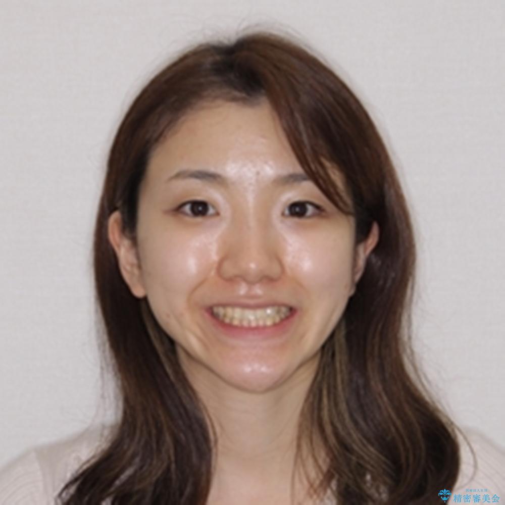 【モニター】1本欠損した下顎前歯と上顎の八重歯 ワイヤー装置で楽して矯正治療の治療前(顔貌)