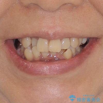 クロスバイトの前歯を治したい　ワイヤー装置でも抜歯矯正の治療前（顔貌）
