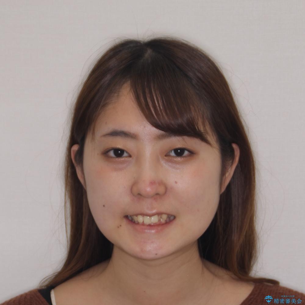 【モニター】下顎前歯の2本欠損 上顎のみの抜歯でバランスを取ったワイヤー矯正の治療前(顔貌)