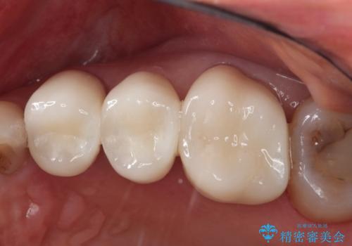 【オールセラミッククラウン】銀歯の下に大きな虫歯の症例 治療後