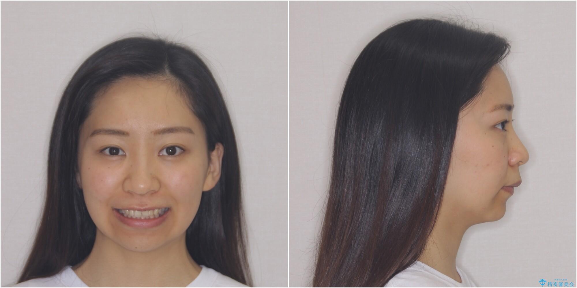 【モニター】閉じにくい口元 ワイヤー装置での抜歯矯正の治療前(顔貌)