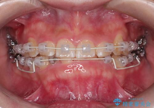 【審美ワイヤー】前歯が見えない。深い噛み合わせの治療の治療中