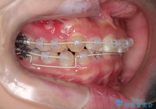 【審美ワイヤー】前歯が見えない。深い噛み合わせの治療の治療中