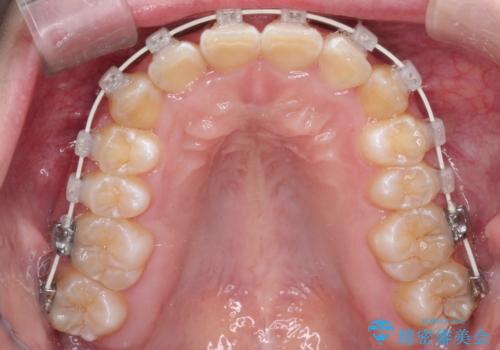 【審美ワイヤー】前歯が見えない。深い噛み合わせの治療の治療中