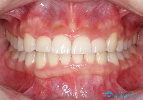 【審美ワイヤー】前歯が見えない。深い噛み合わせの治療の症例 治療後