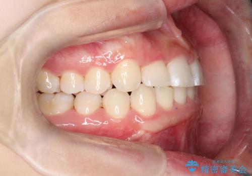 【審美ワイヤー】前歯が見えない。深い噛み合わせの治療の治療後