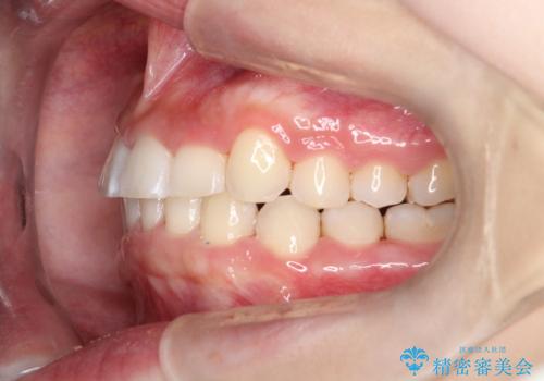 【審美ワイヤー】前歯が見えない。深い噛み合わせの治療の治療後