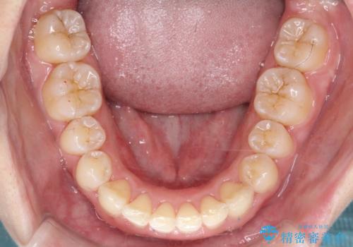 【審美ワイヤー】前歯が見えない。深い噛み合わせの治療の治療後