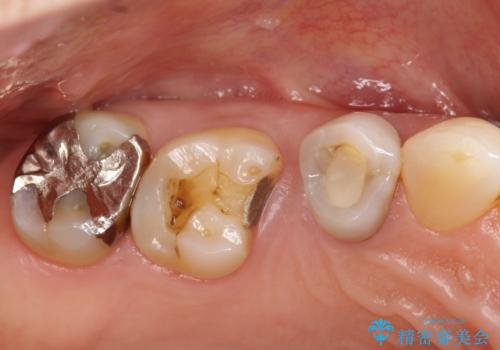 【セラミッククラウン】インレーが外れた。の治療前