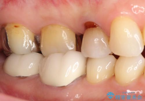 【セラミッククラウン】インレーが外れた。の治療前