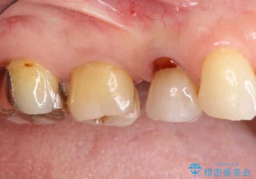 【セラミッククラウン】インレーが外れた。の治療前