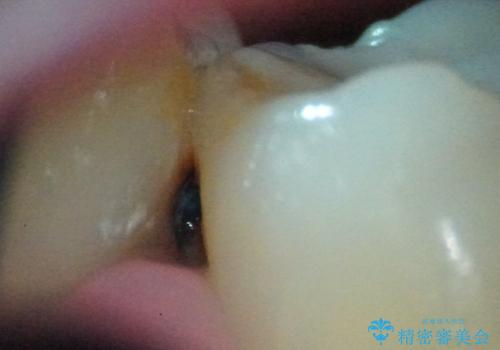 【セラミックインレー】定期検診で見つかった虫歯。の治療前