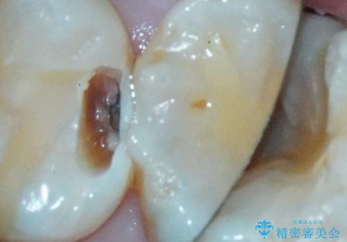 【セラミックインレー】定期検診で見つかった虫歯。の治療後