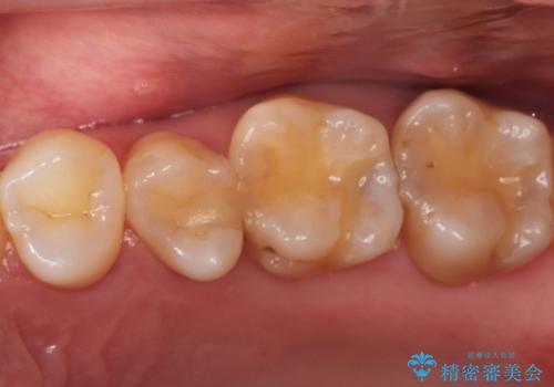 【セラミックインレー】定期検診で見つかった虫歯。の治療前