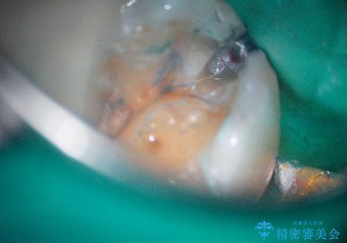 【根管治療】噛んだ時にしみる。最近になってズキズキ痛み、長引く痛みがある
