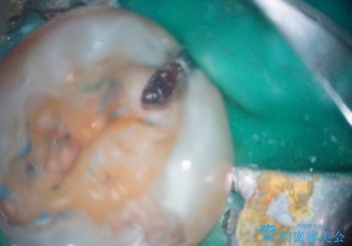 【根管治療】噛んだ時にしみる。最近になってズキズキ痛み、長引く痛みがあるの治療中