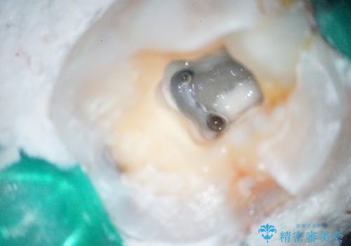 【根管治療】噛んだ時にしみる。最近になってズキズキ痛み、長引く痛みがあるの治療前