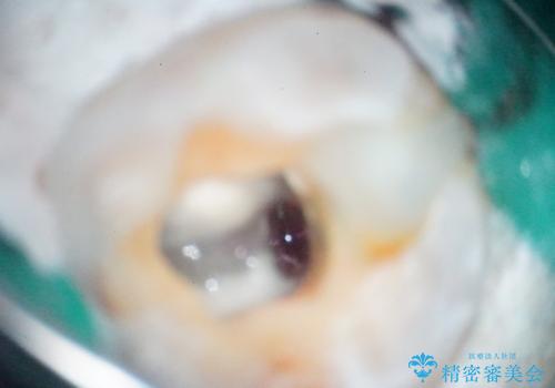 【根管治療】噛んだ時にしみる。最近になってズキズキ痛み、長引く痛みがあるの治療中