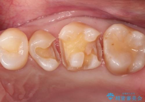 【セラミックインレー】定期検診で見つかった虫歯。の治療中