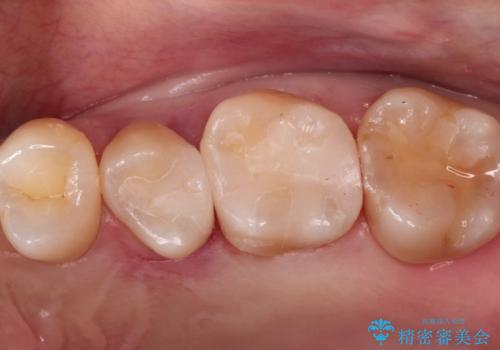 【セラミックインレー】定期検診で見つかった虫歯。