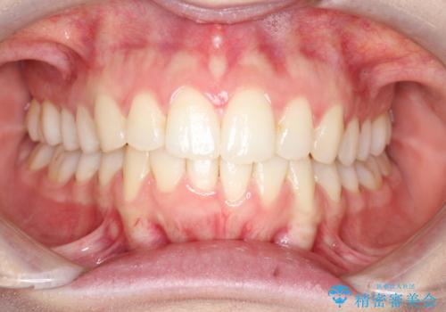 【インビザライン】前歯のガタガタをなおしたい。の治療後