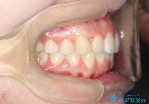 【インビザライン】前歯のガタガタをなおしたい。の治療後