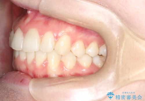 【インビザライン】前歯のガタガタをなおしたい。の治療後
