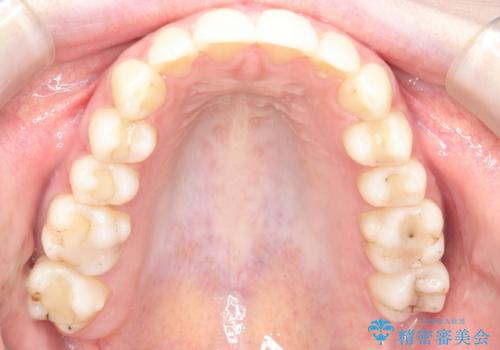 【インビザライン】前歯のガタガタをなおしたい。の治療後