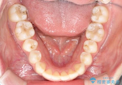 【インビザライン】前歯のガタガタをなおしたい。の治療後