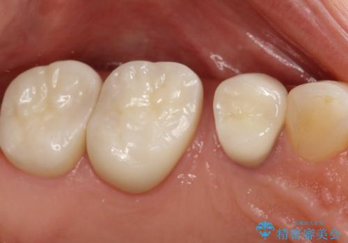 【セラミッククラウン】インレーが外れた。の治療後