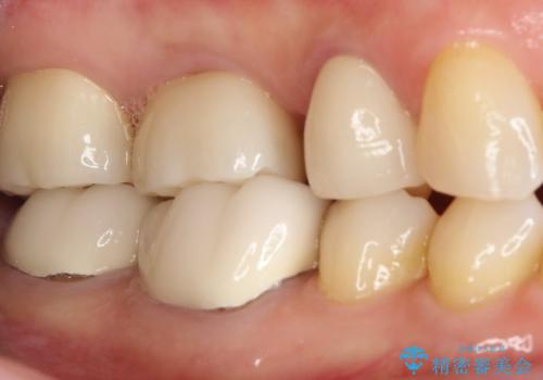 【セラミッククラウン】インレーが外れた。の治療後