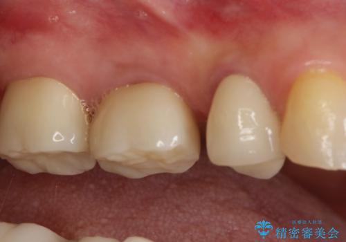 【セラミッククラウン】インレーが外れた。の治療後