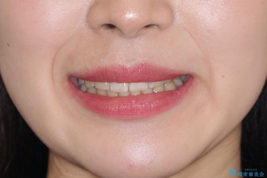 【審美ワイヤー】前歯が見えない。深い噛み合わせの治療の治療後(顔貌)