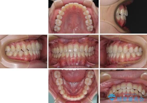 前歯のクロスバイトをワイヤー矯正で 結婚式までに治したいの治療後