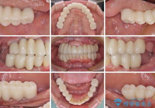 歯周病で痛い 全顎的歯周病治療の治療後
