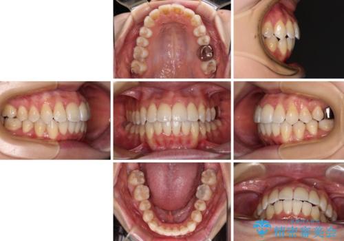 【モニター】急速拡大装置 狭い歯列を拡大してワイヤー装置で短期間治療の治療後