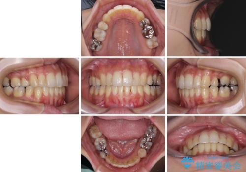 後戻りで突出した前歯をインビザラインで解消の治療後