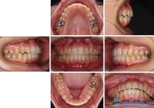 舌突出癖による開咬 舌のトレーニングを行いながら咬み合わせを改善の治療後