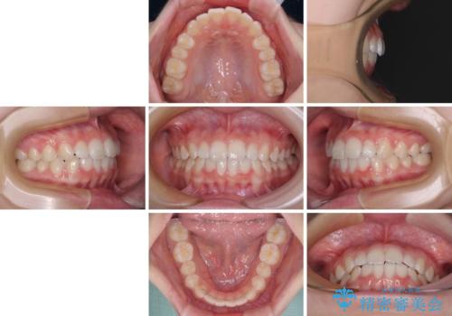 前歯のデコボコを治したい 高校生のインビザライン治療の治療後