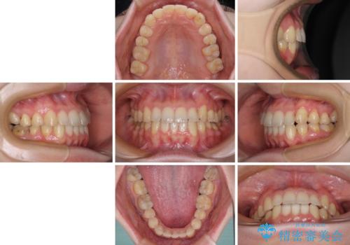 【モニター】1本欠損した下顎前歯と上顎の八重歯 ワイヤー装置で楽して矯正治療の治療後