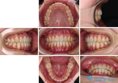 【モニター】捻れた前歯をスッキリと インビザライン矯正治療の治療後