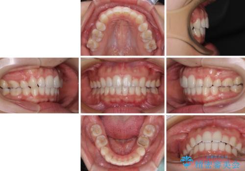 【モニター】閉じにくい口元 ワイヤー装置での抜歯矯正の治療後