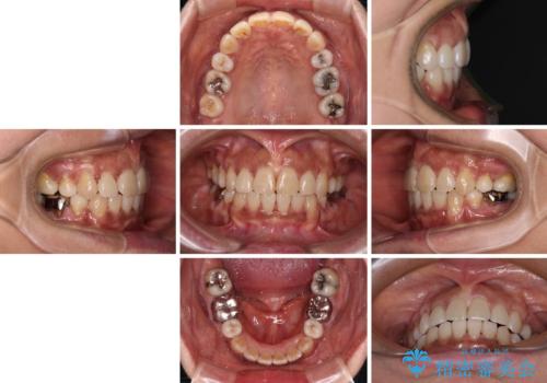 クロスバイトの前歯を治したい ワイヤー装置でも抜歯矯正の治療後