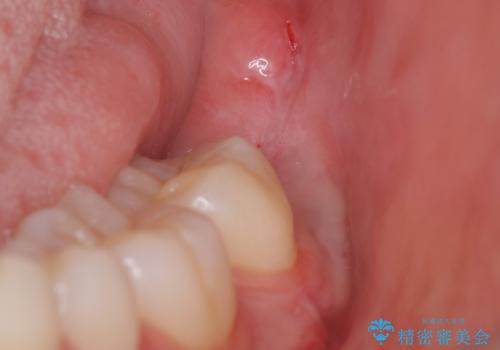 親知らずを抜きたいの治療後