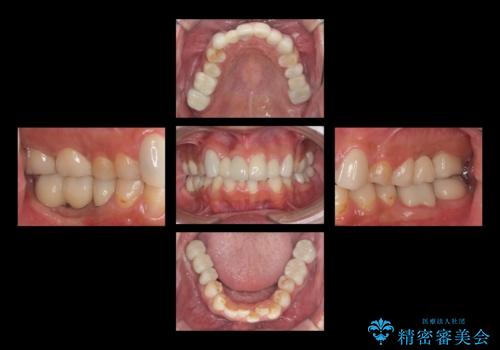 短期間で歯並びをきれいにしたい セラミックでかぶせる治療でも良いの治療後