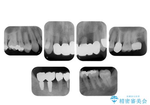 受け口 なんと部分矯正で治るんです!! インプラントを含めた総合歯科治療の治療後